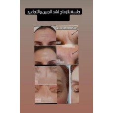 ﻿Plasma session with Hydra Facial 