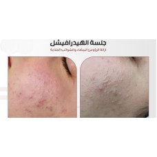 Hydrafacial session