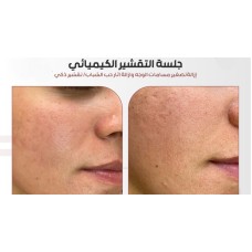 Chemical peeling session