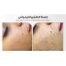 Chemical peeling session