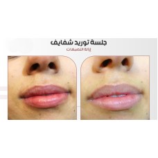 Lip augmentation session