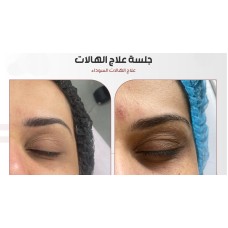Dark circles treatment session