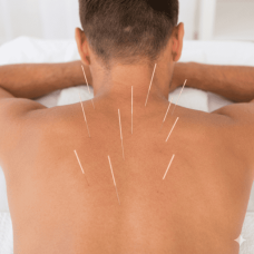  Acupuncture Therapy Session 